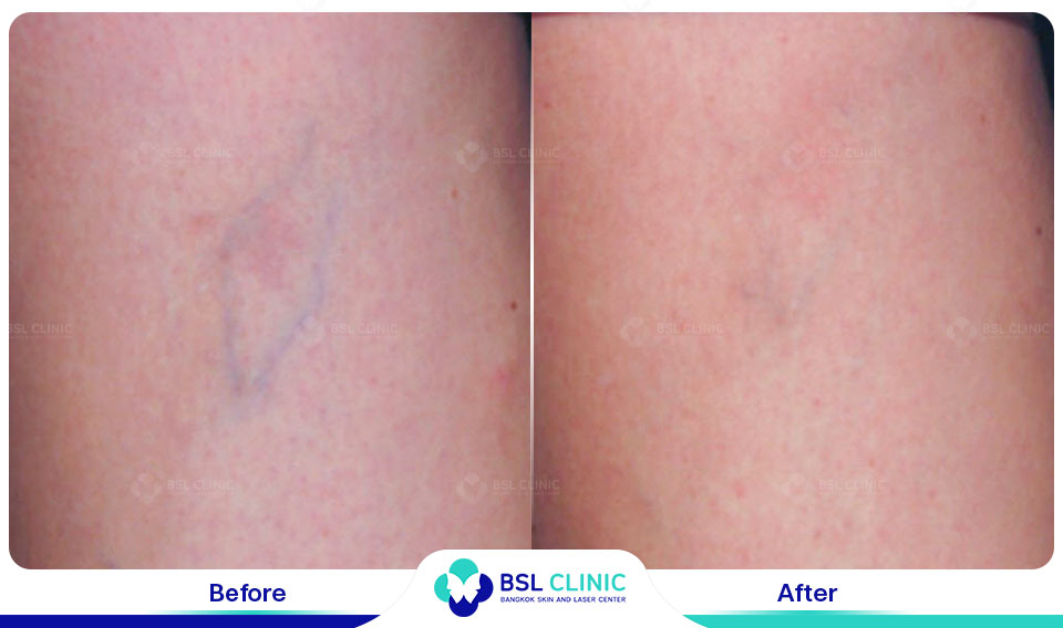 results Sclerotherapy