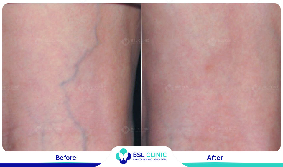 results Sclerotherapy