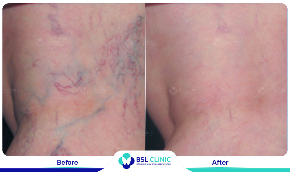 results Sclerotherapy