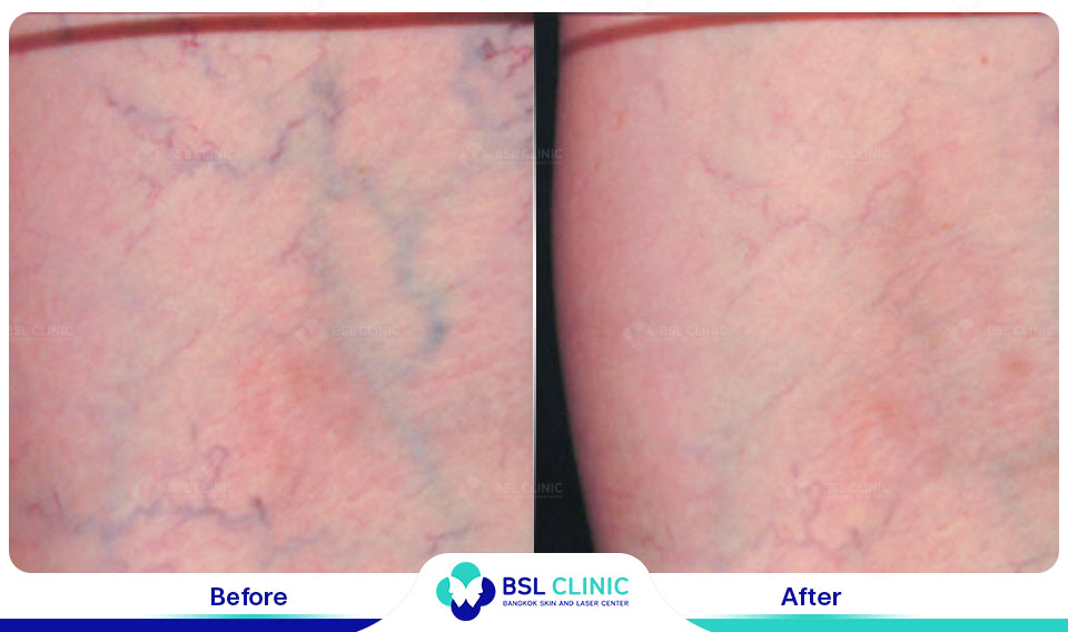 results-Sclerotherapy
