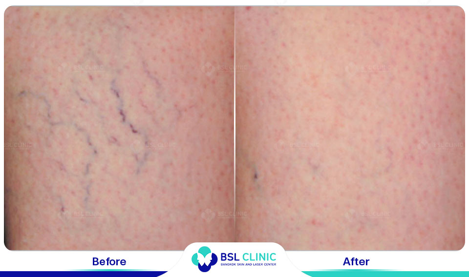 results-Sclerotherapy