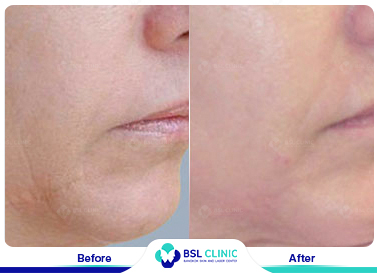 results The Skin Tightening Forma