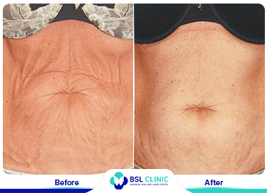 results The Skin Tightening Forma