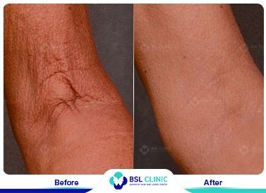 results The Skin Tightening Forma