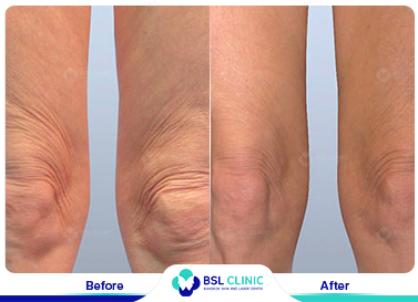 results The Skin Tightening Forma