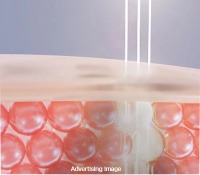 Melasma Pigmentation Reduction Laser