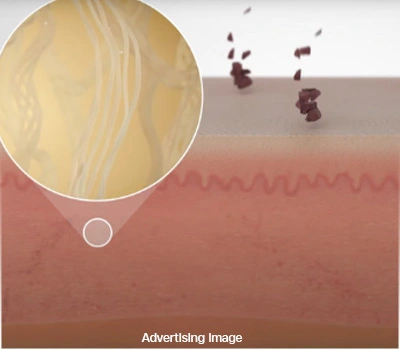 Melasma Pigmentation Removal Laser