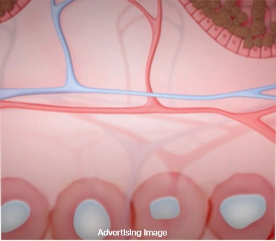 Melasma Laser for Strengthening the Skin