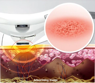 Laser for Vascular Melasma
