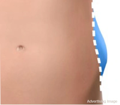 visible fat reduction results after coolshaping fat freezing cryolipolysis treatment double chin thighs