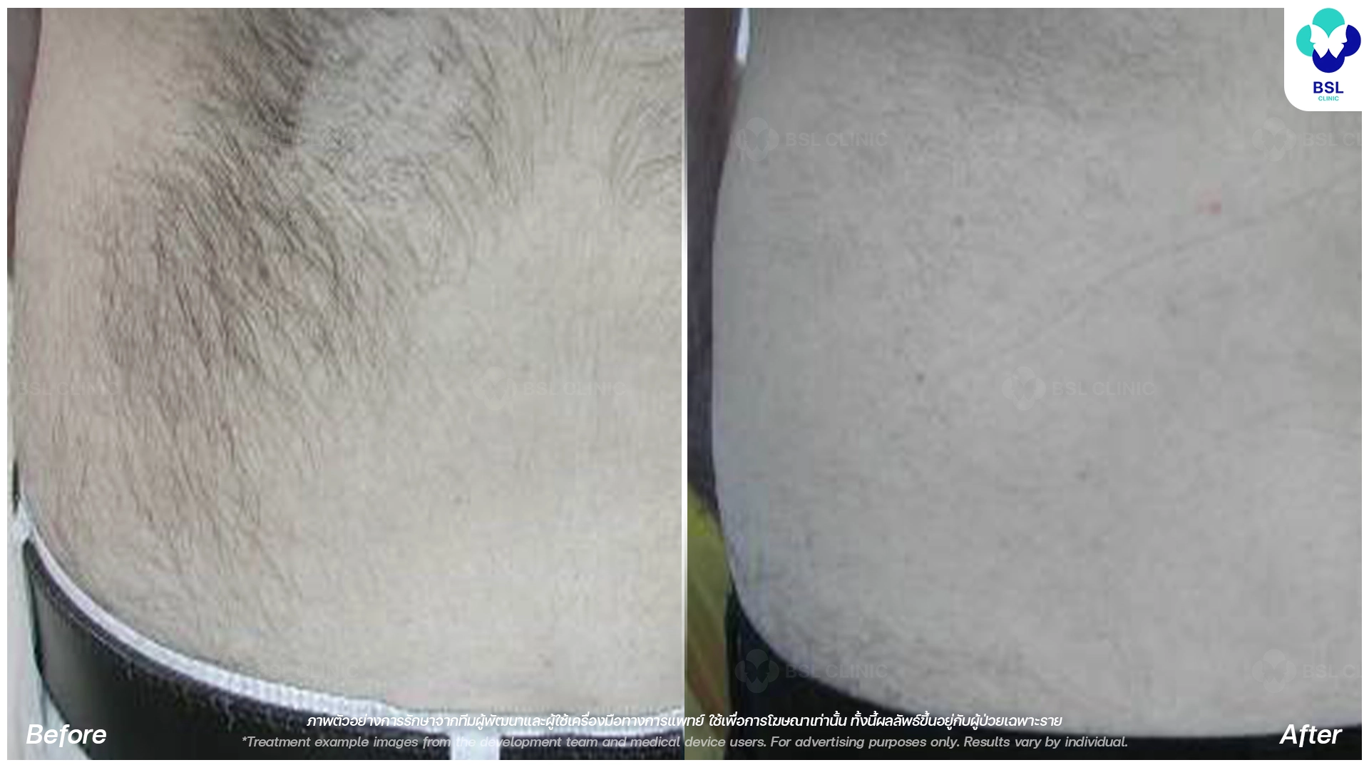 before after Hair Removal