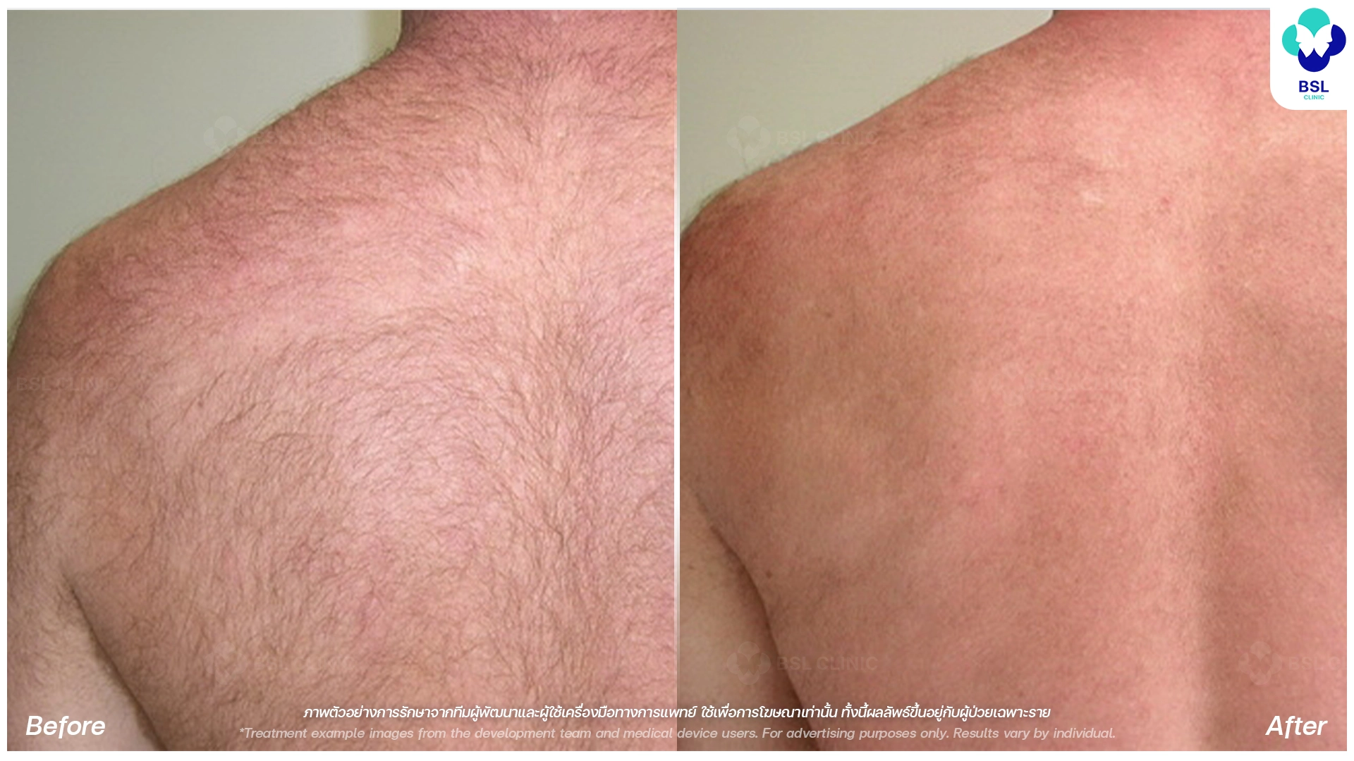 before after Hair Removal