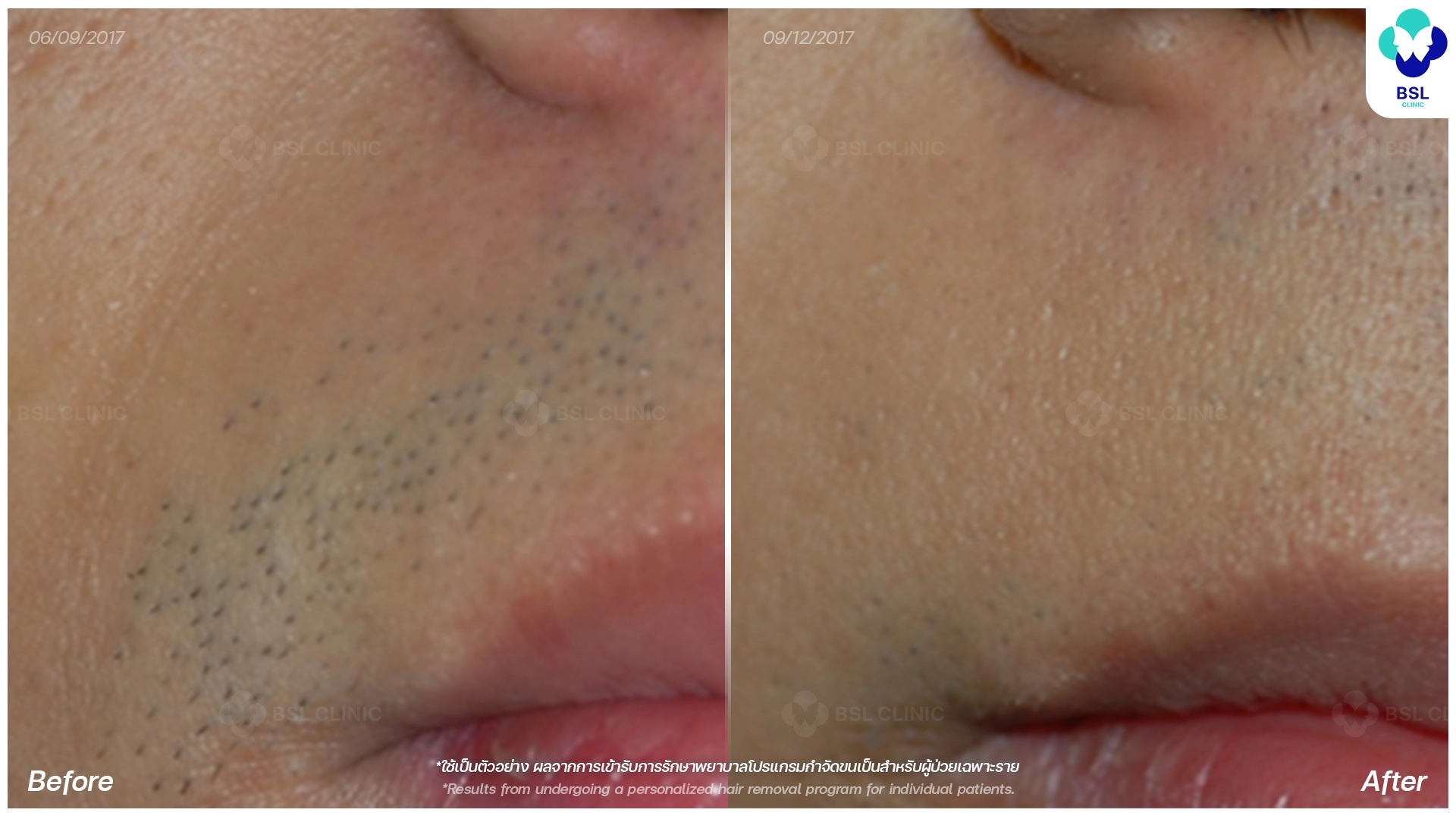 before after Hair Removal