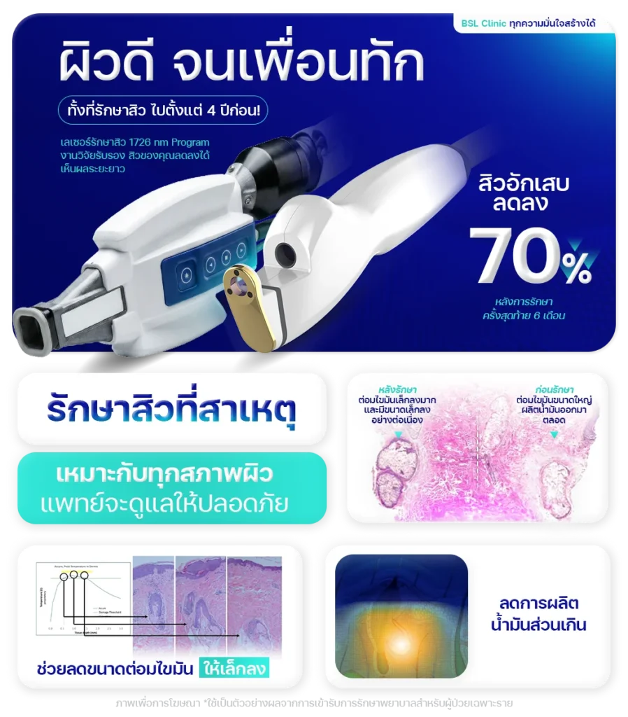 รักษาสิวไปตั้งแต่-4-ปีก่อน_เลเซอร์รักษาสิว-1726-nm