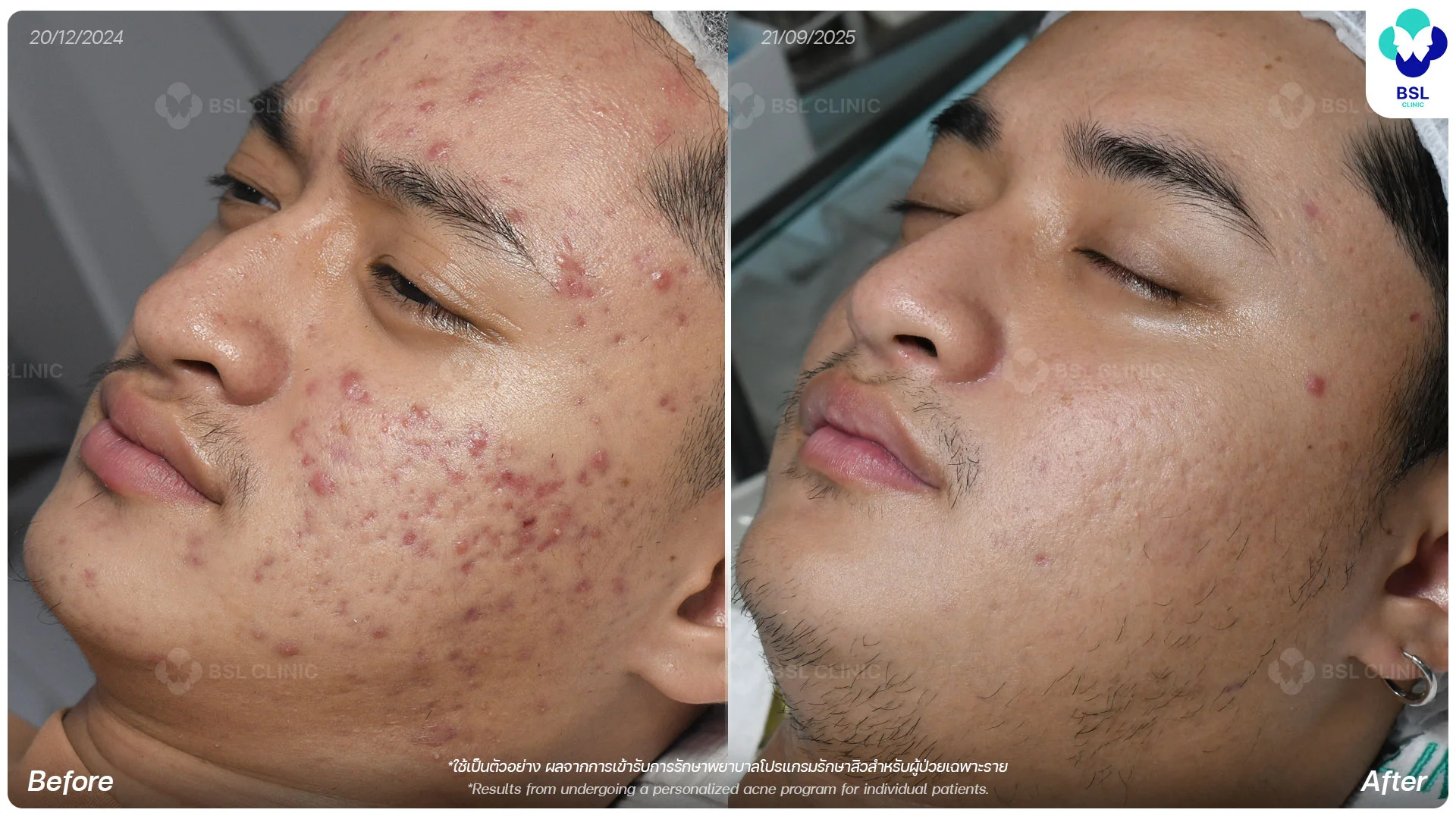 สิว-หลุมสิว-Accure