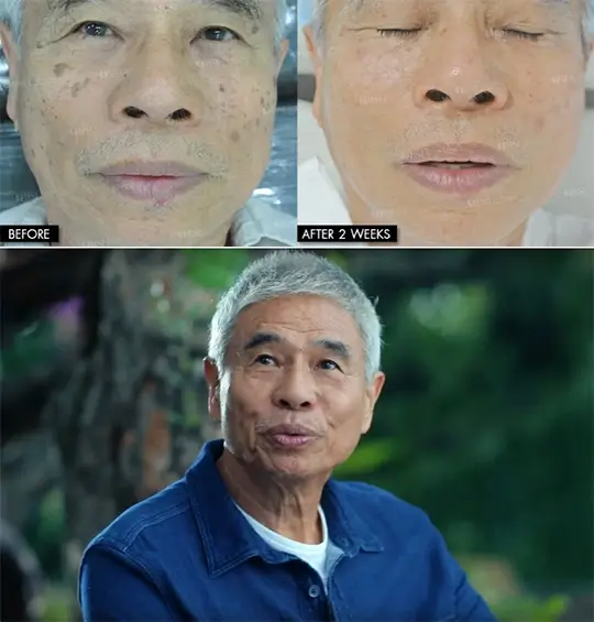 result after Seborrhoeic Keratosis Treatment