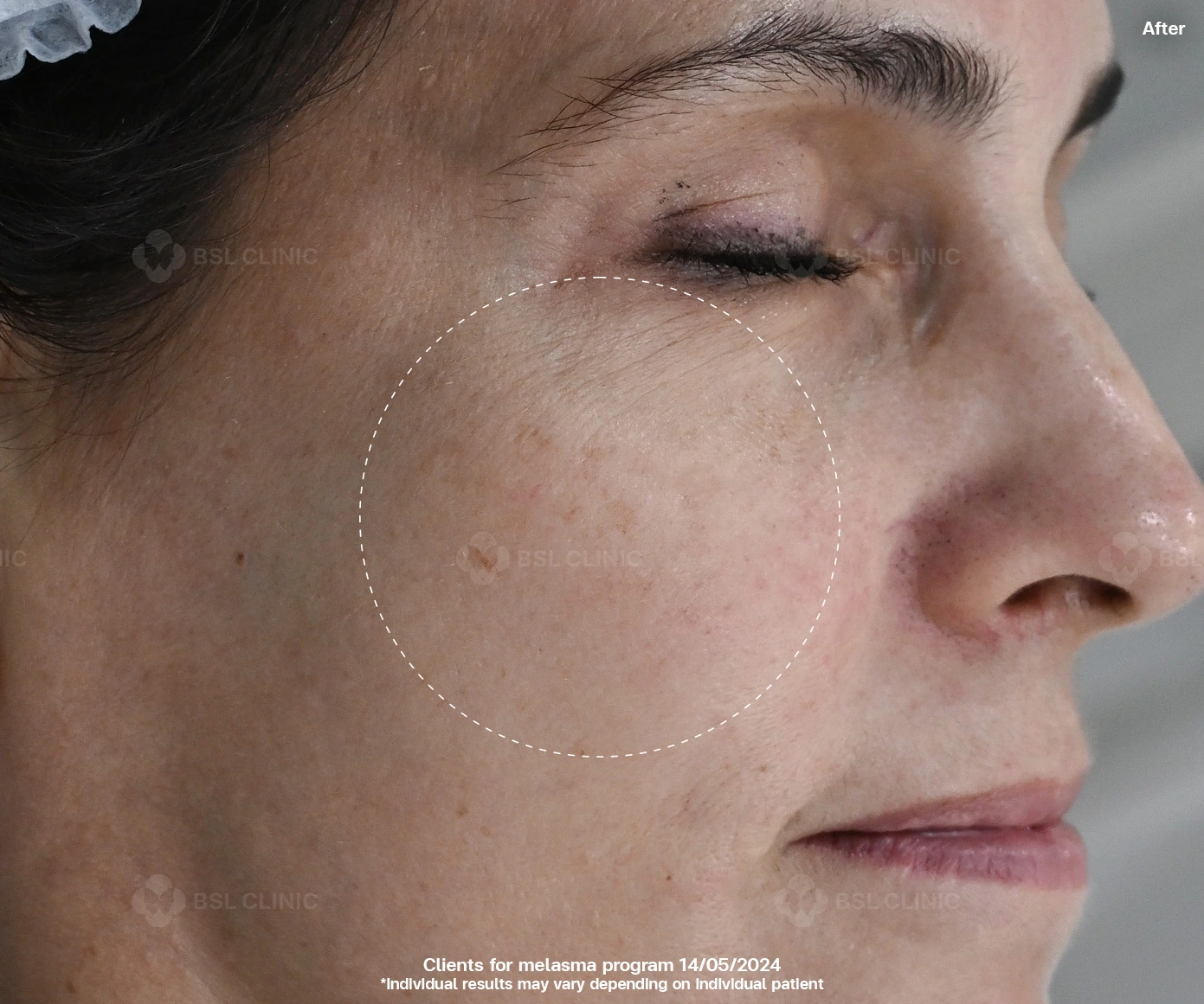 After result melasma