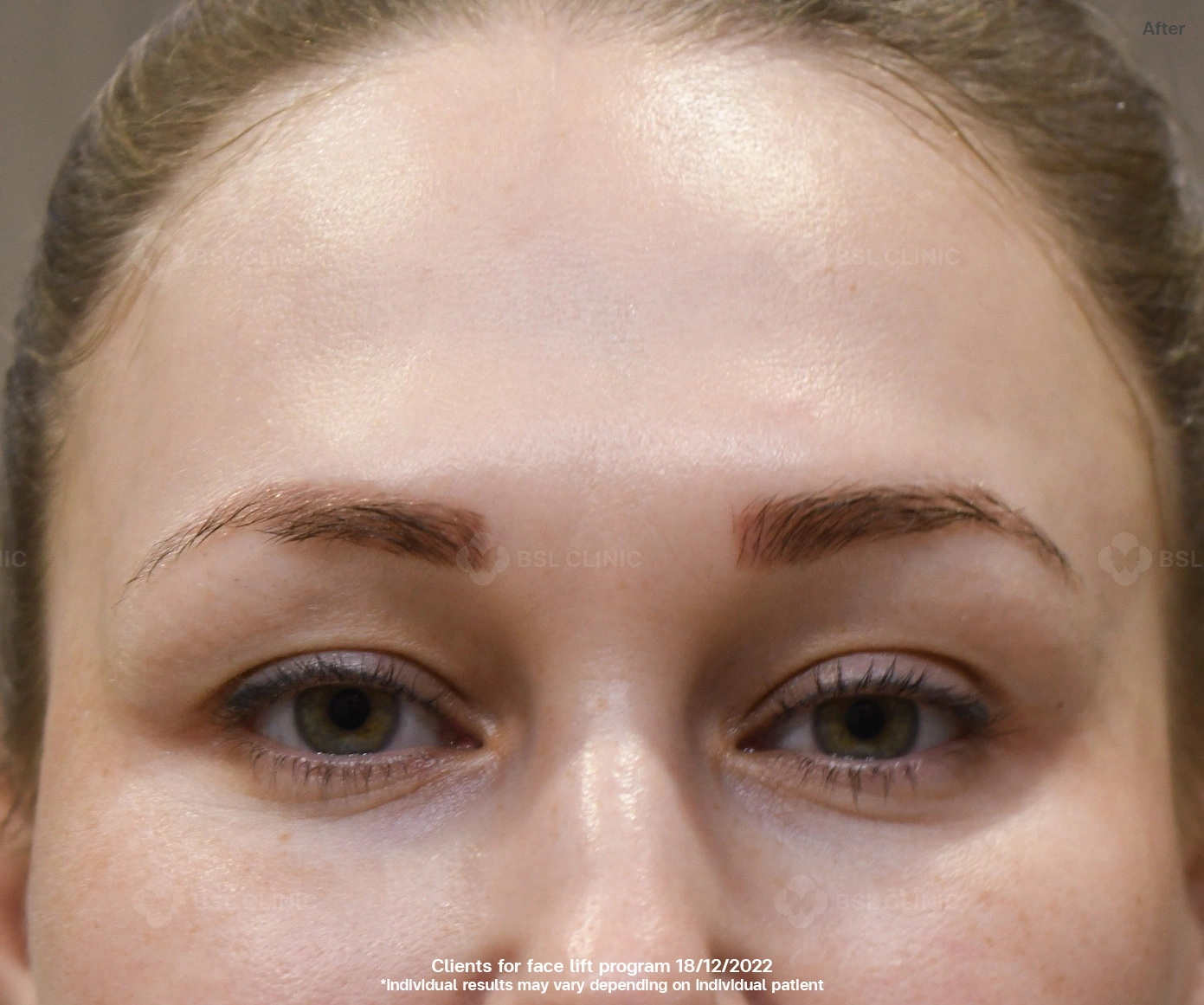 After-result-morpheus8-facial-
