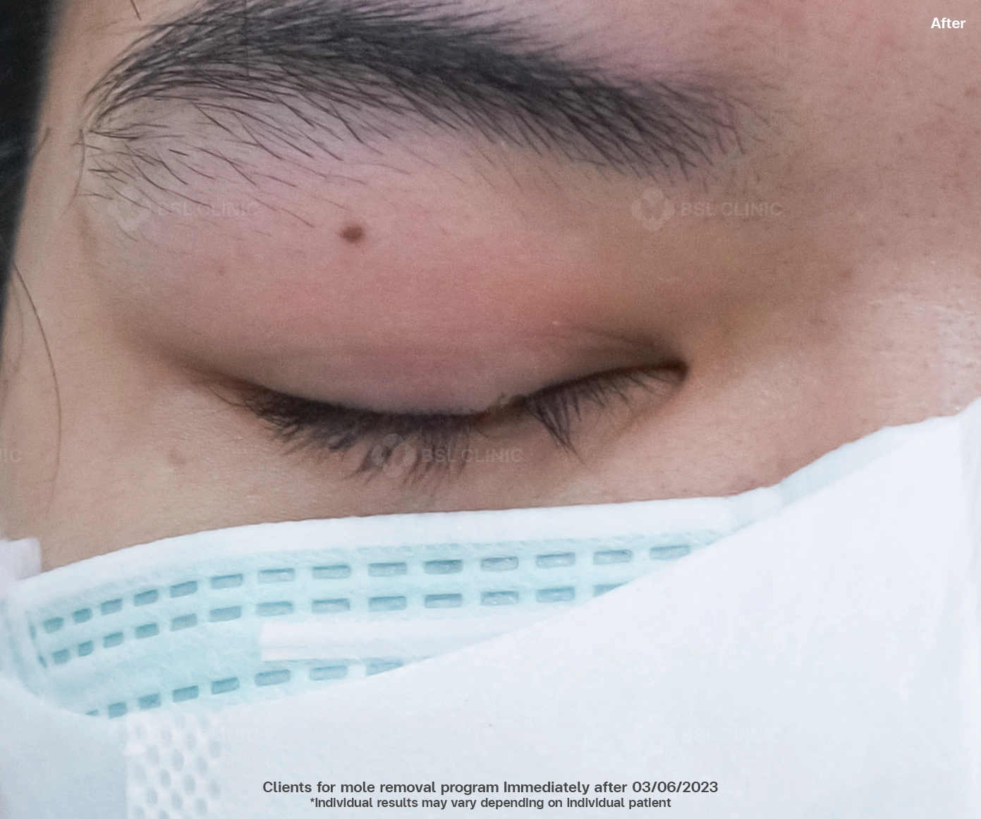 after co2 laser bangkok mole removal near eyelid at bsl clinic thailand gentle skin tag removal bangkok price safe treatment for milia syringoma co2 laser thailand clear skin results bangkok mole removal