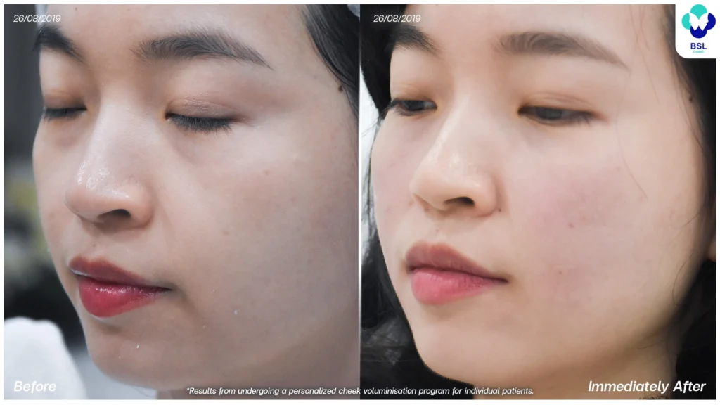 ยกกระชับหน้า ลดความหย่อนคล้อยให้กรอบหน้าดูชัดขึ้น