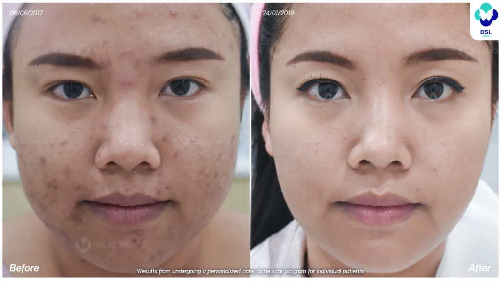 โปรแกรมรักษารอยดำสิว *ใช้เป็นตัวอย่างผลจากการเข้ารับการรักษาพยาบาลสำหรับผู้ป่วยเฉพาะราย