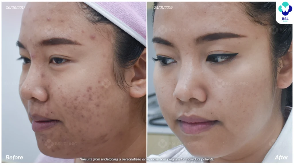 โปรแกรมรักษารอยดำสิว *ใช้เป็นตัวอย่างผลจากการเข้ารับการรักษาพยาบาลสำหรับผู้ป่วยเฉพาะราย