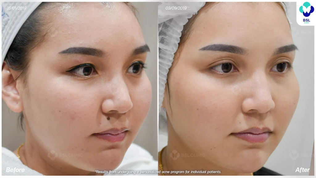โปรแกรมรักษาผิวแพ้ง่าย *ใช้เป็นตัวอย่างผลจากการเข้ารับการรักษาพยาบาลสำหรับผู้ป่วยเฉพาะราย