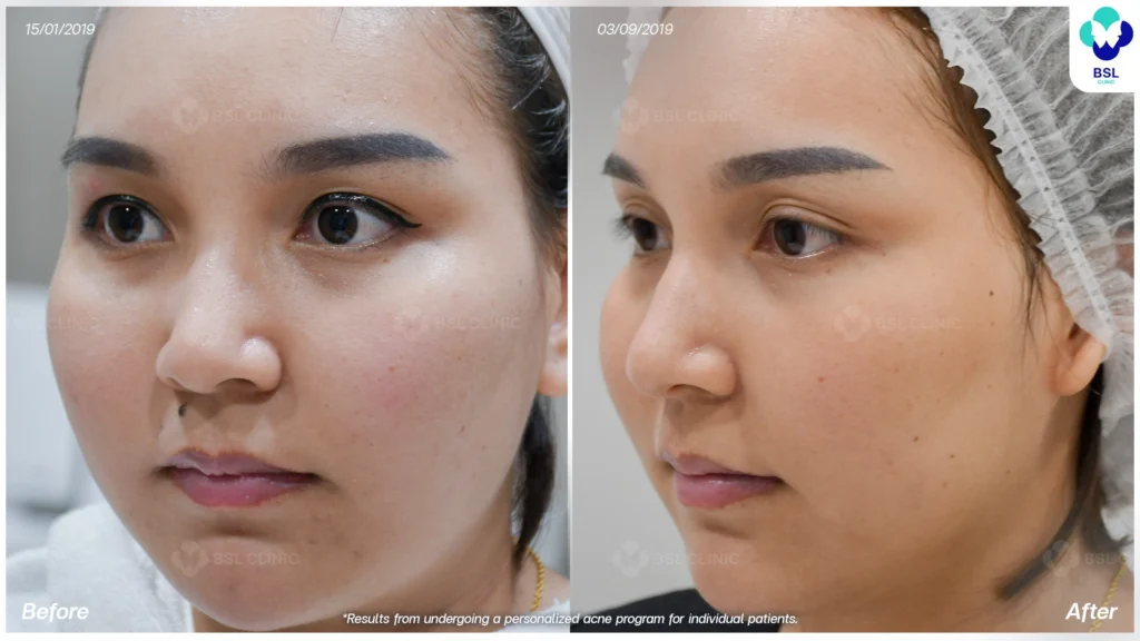 โปรแกรมรักษาผิวแพ้ง่าย *ใช้เป็นตัวอย่างผลจากการเข้ารับการรักษาพยาบาลสำหรับผู้ป่วยเฉพาะราย