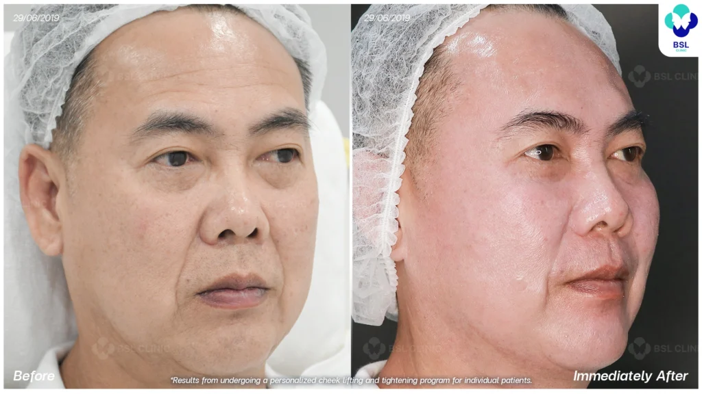 ยกกระชับหน้า ลดความหย่อนคล้อยให้กรอบหน้าดูชัดขึ้น