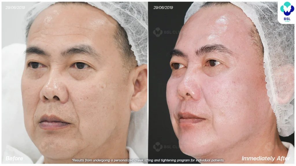 ยกกระชับหน้า ลดความหย่อนคล้อยให้กรอบหน้าดูชัดขึ้น