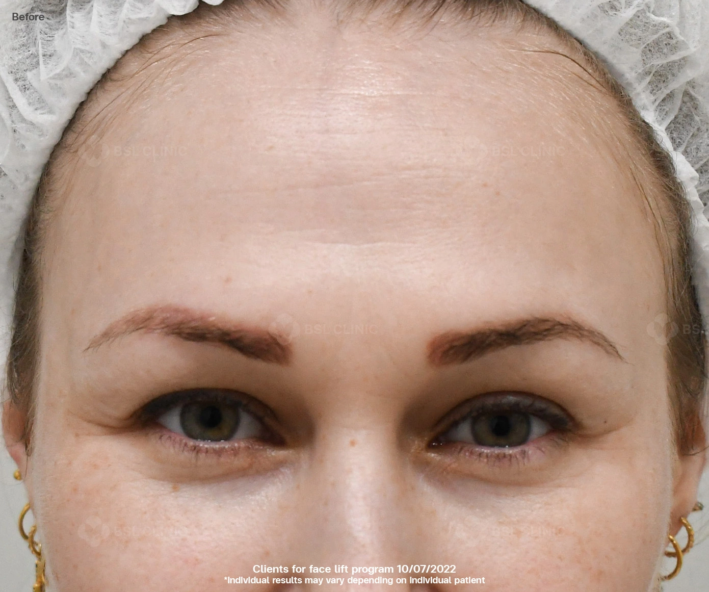 morpheus8 bangkok before and after results morpheus8 treatment for facial tightening and wrinkle reduction morpheus8 face rejuvenation what is morpheus8 morpheus8 bangkok price 01