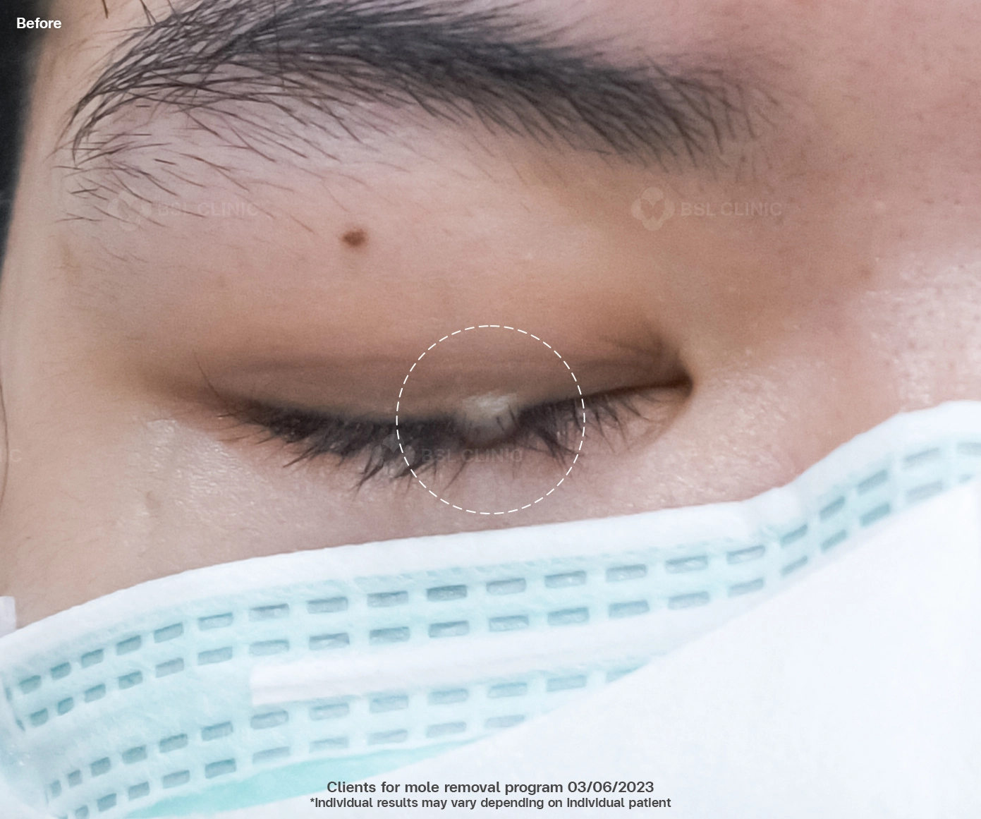 before and after skin tag removal bangkok using co2 laser thailand bsl clinic safe precise treatment for mole removal milia syringoma and pre cancerous lesions such as actinic keratosis co2 laser bangkok price skin tag removal thailand bangkok mole removal results