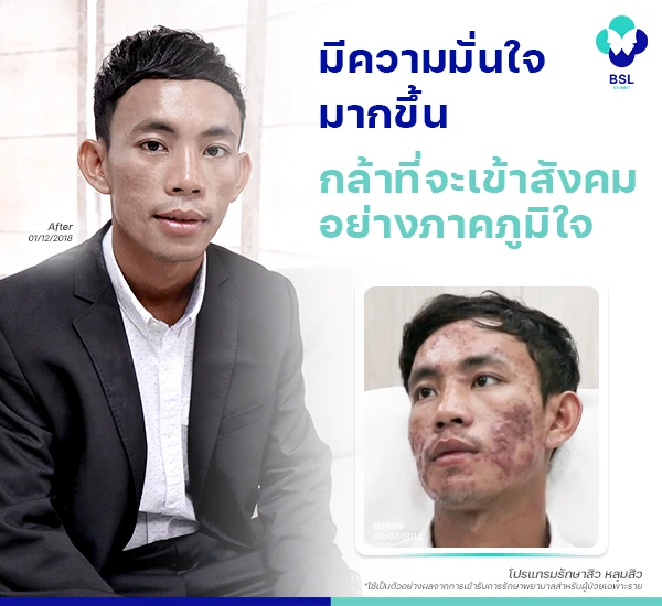 โครงการรักษาสิวฟรี Season 2 BSL Clinic