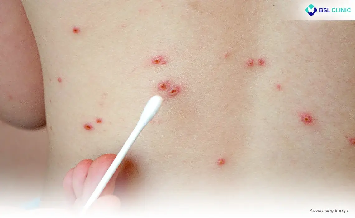 Chickenpox Preventative Measures