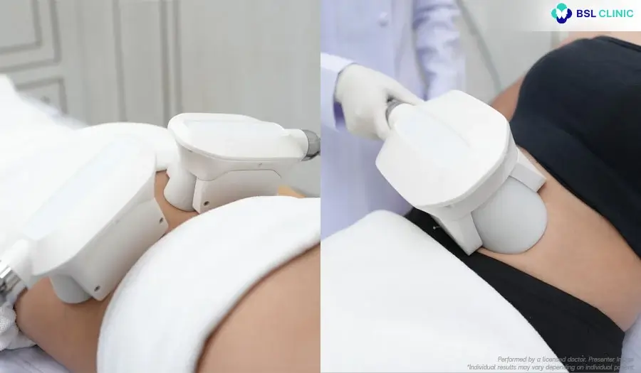 Combining Technologies for Body Contouring