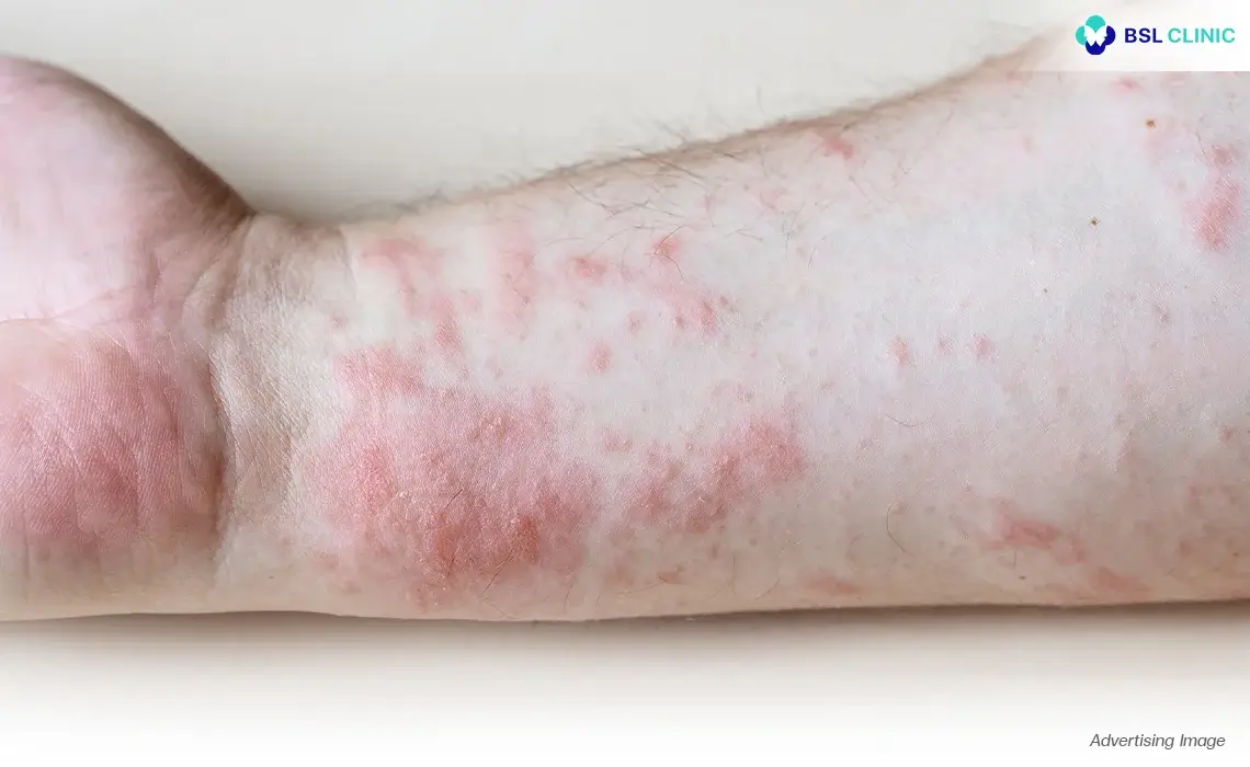 Dermatitis, Eczema and Skin Rash