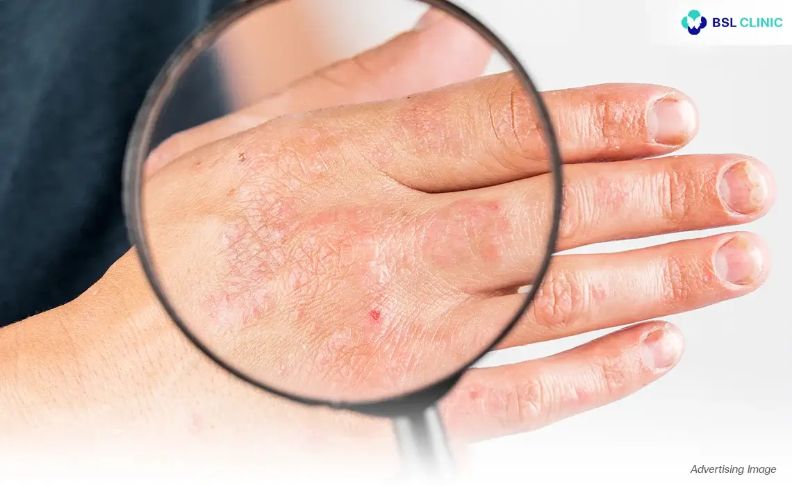 Dermatitis, Eczema and Skin Rash