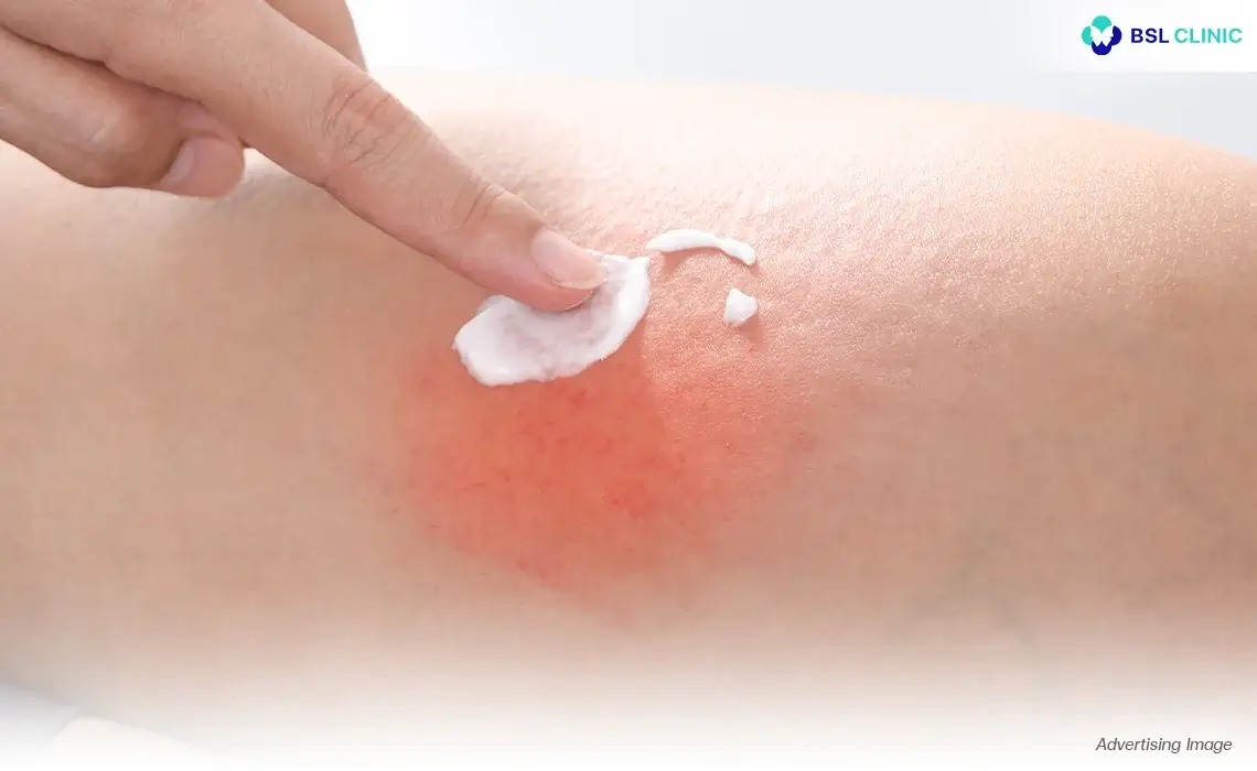 Dermatitis, Eczema and Skin Rash