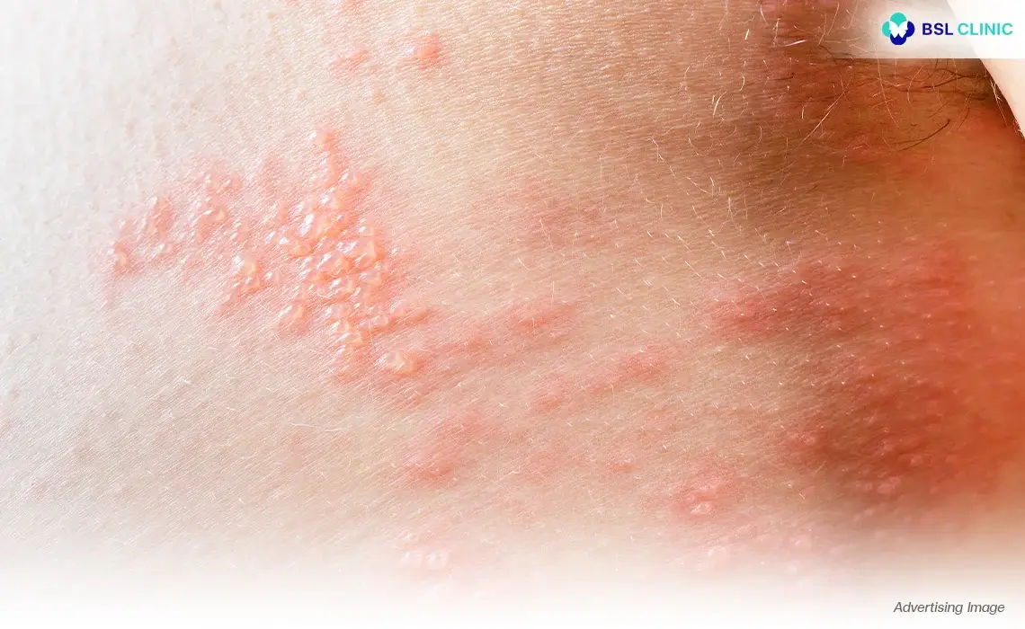 Dermatitis, Eczema and Skin Rash