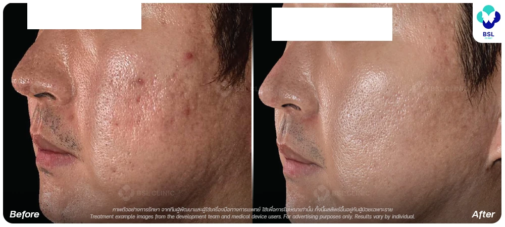 Juvelook-EN-BA-Atrophic-scars