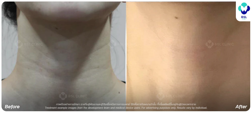 Juvelook-EN-BA-Neck-Wrinkle