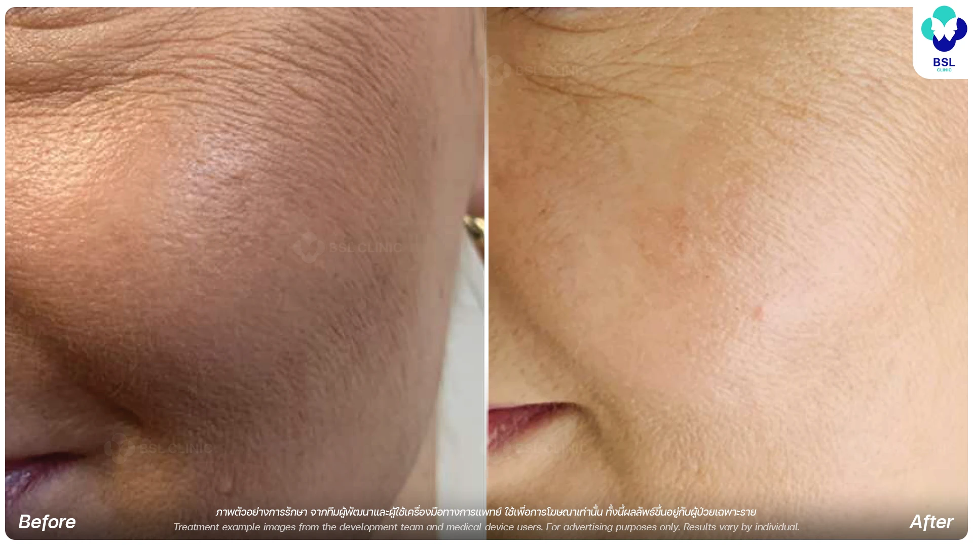 Juvelook-EN-BA-Skin-Rejuvenation
