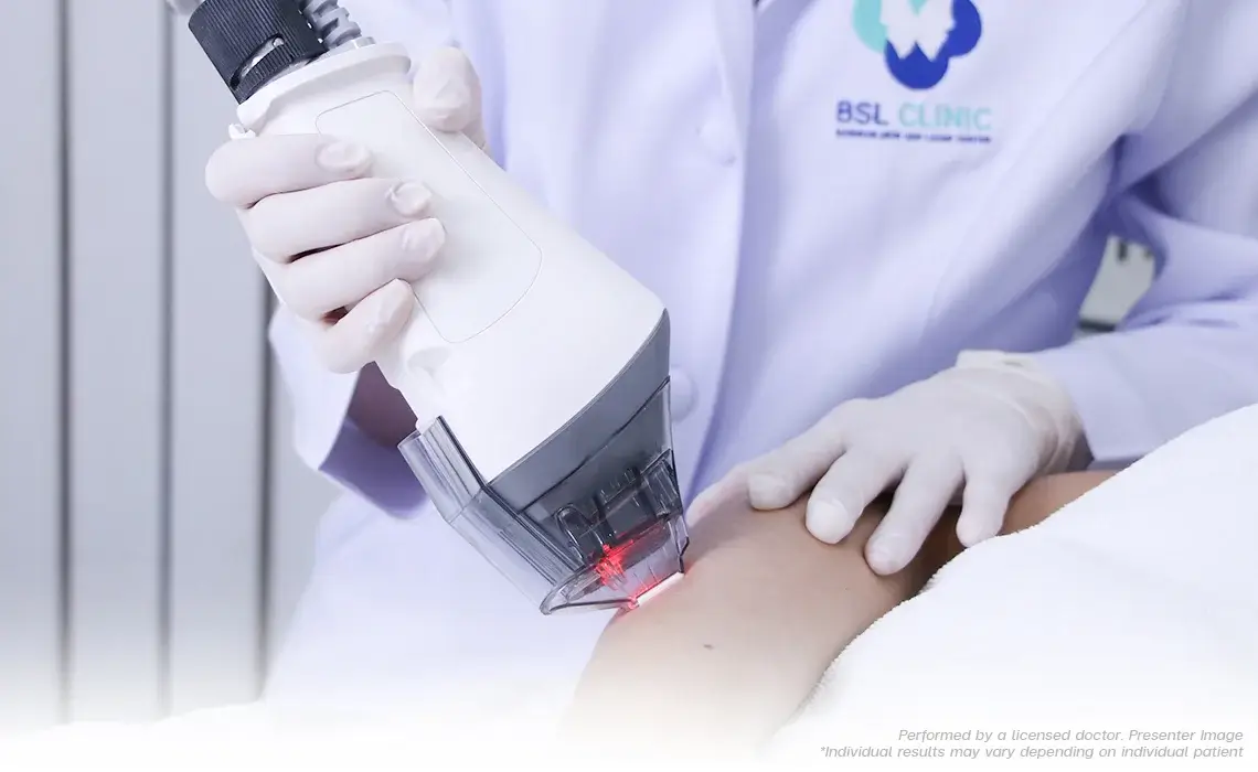 Laser can be utilised for the treatment of stretch marks