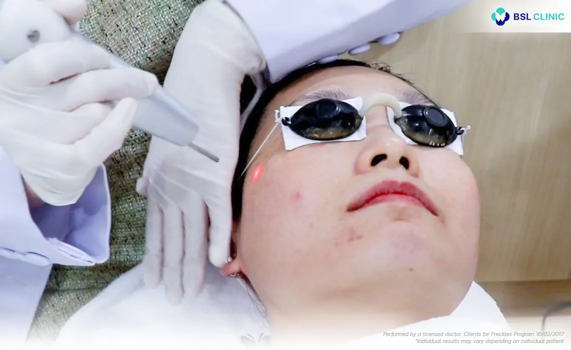 Patient Story freckle removal laser treatment