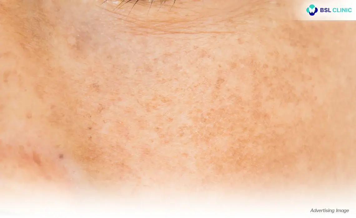 The Causes of Melasma