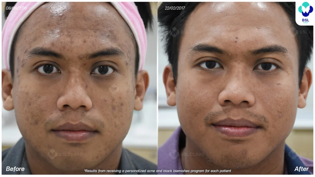 โปรแกรมรักษารอยดำสิว *ใช้เป็นตัวอย่างผลจากการเข้ารับการรักษาพยาบาลสำหรับผู้ป่วยเฉพาะราย