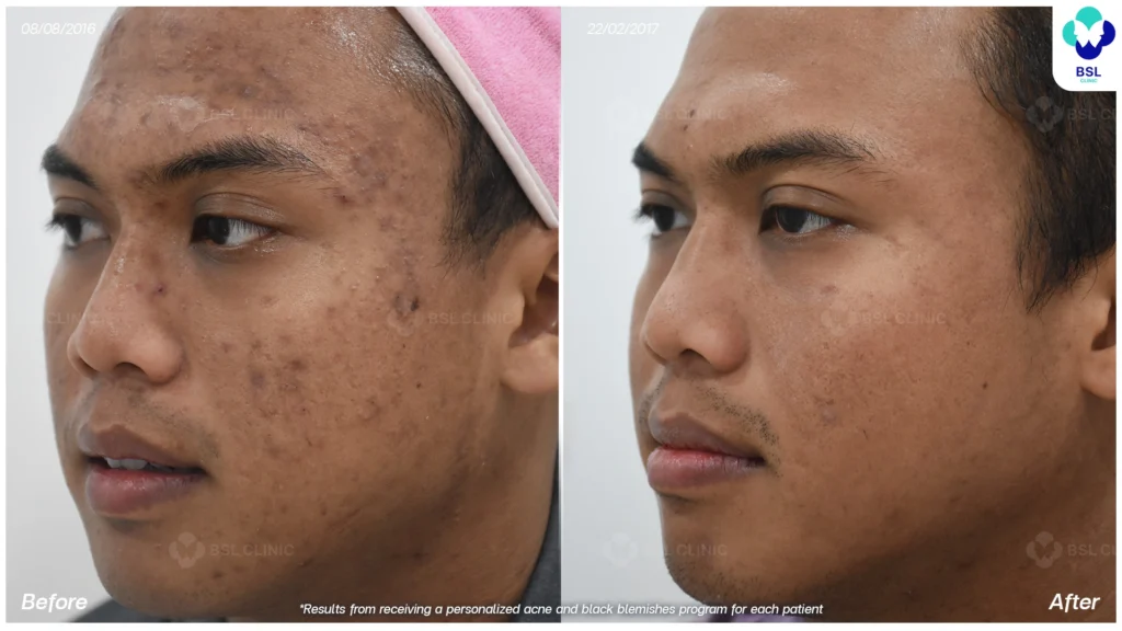 โปรแกรมรักษารอยดำสิว *ใช้เป็นตัวอย่างผลจากการเข้ารับการรักษาพยาบาลสำหรับผู้ป่วยเฉพาะราย