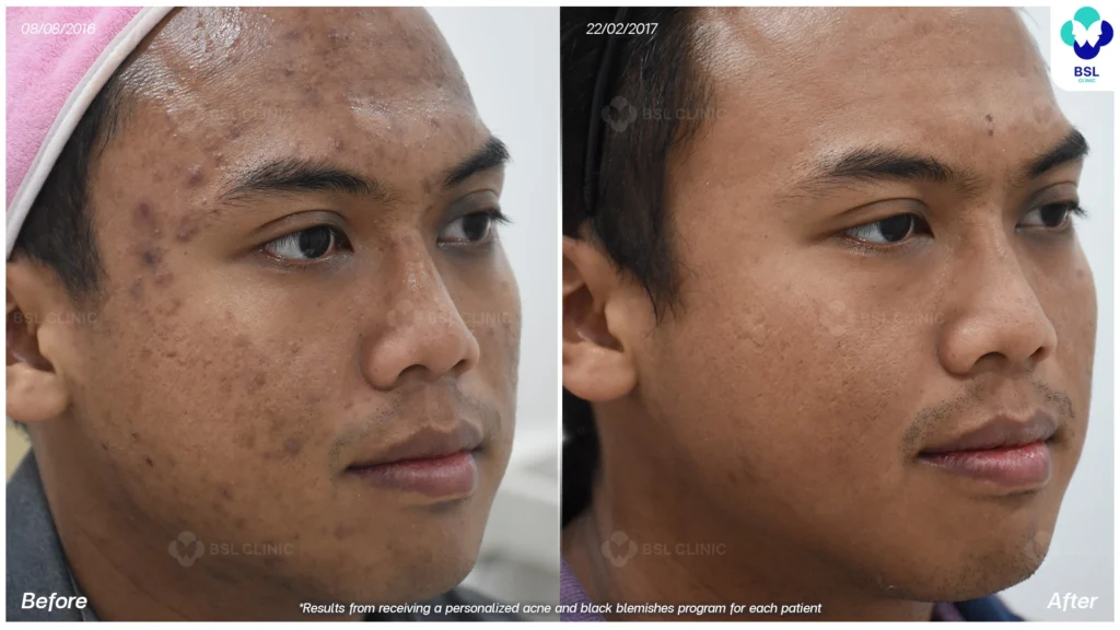 โปรแกรมรักษารอยดำสิว *ใช้เป็นตัวอย่างผลจากการเข้ารับการรักษาพยาบาลสำหรับผู้ป่วยเฉพาะราย