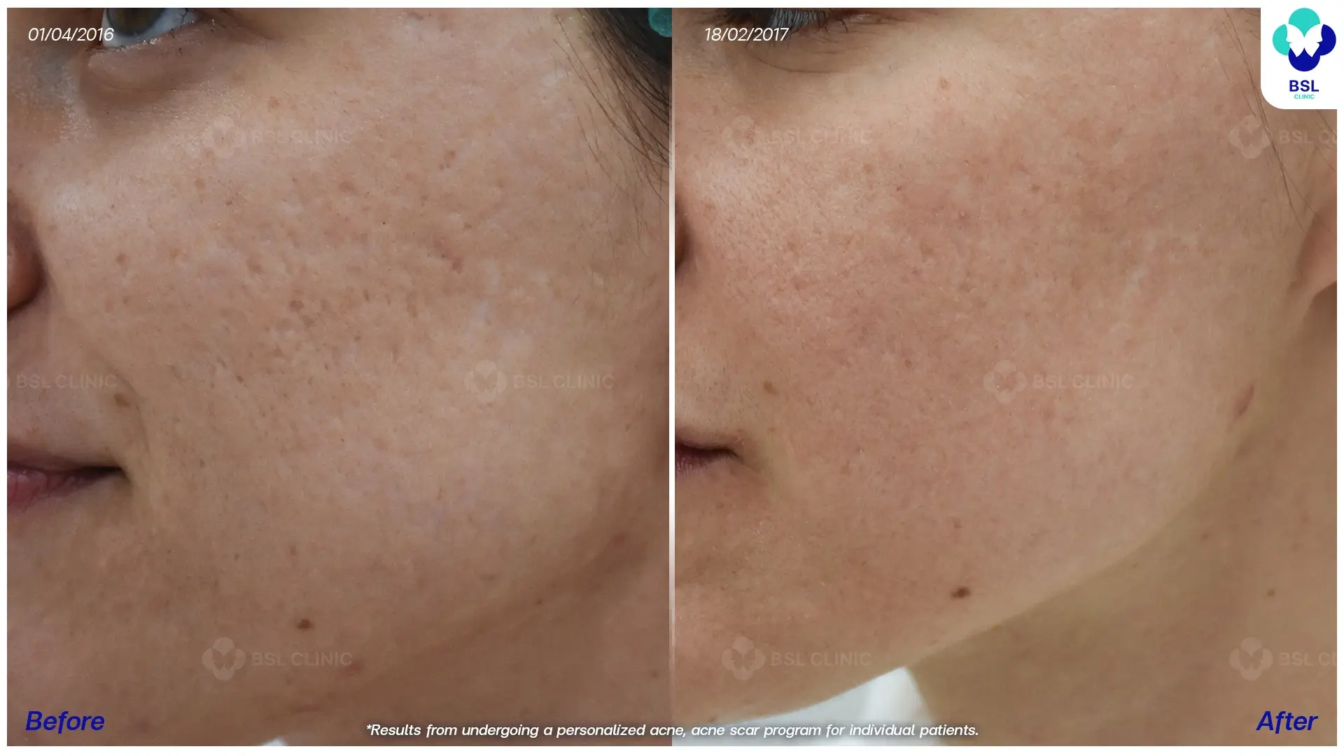 acne scar