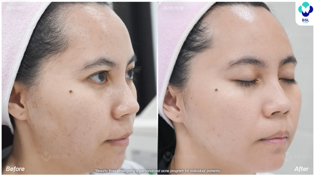 โปรแกรมรักษาผิวแพ้ง่าย *ใช้เป็นตัวอย่างผลจากการเข้ารับการรักษาพยาบาลสำหรับผู้ป่วยเฉพาะราย
